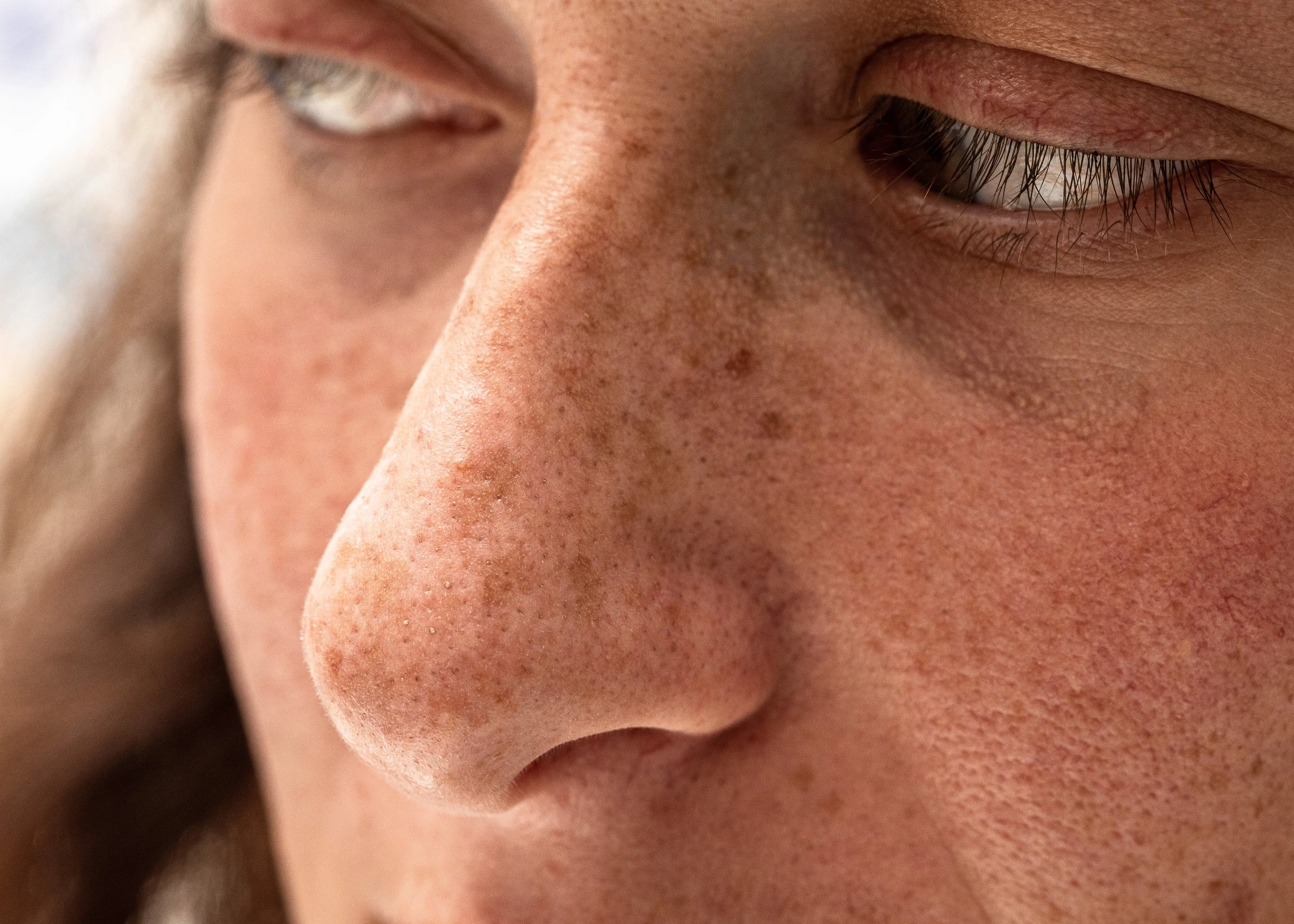 Dye VL — Vascular Lesions